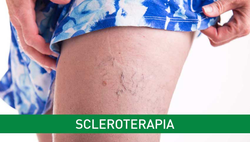 scleroterapia capillari